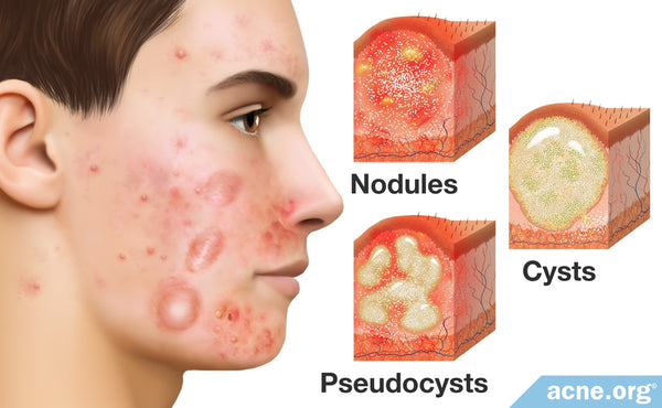 Cystic Acne On The Neck Causes And Treatment Misumi Luxury