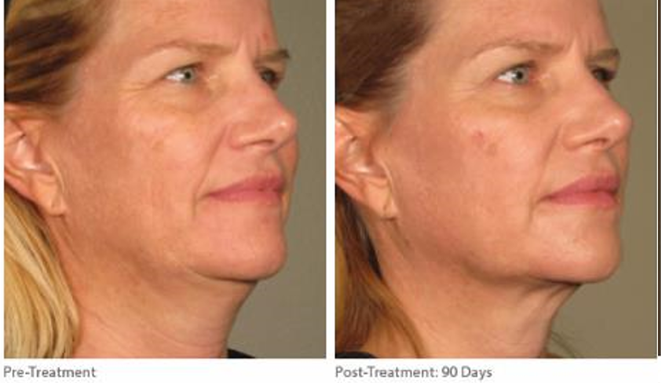 Before and After Ultherapy Treatment Cheeks Neck Jowls London