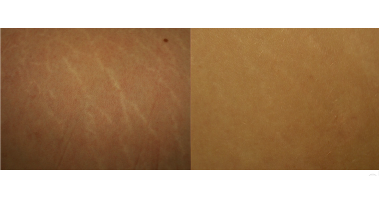 Stretch marks microneedling before and after