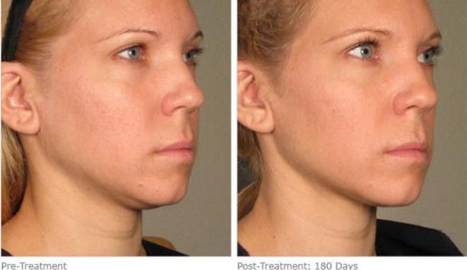 Ultherapy Before and After 30s Woman