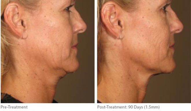 Ultherapy Before and After Shot Sagging Neck Skin Cheeks and Jawline