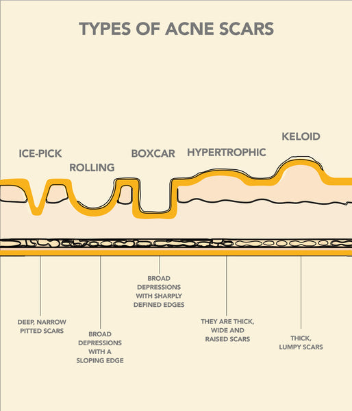 This is an image of Types of Acne Scars on www.sublimelife.in 