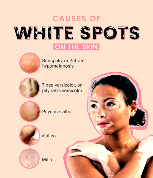 This is an image of causes of white spots on the skin on www.sublimelife.in