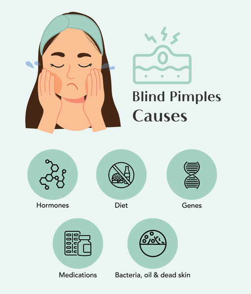 This is an image of Causes of Blind Pimples on www.sublimelife.in 
