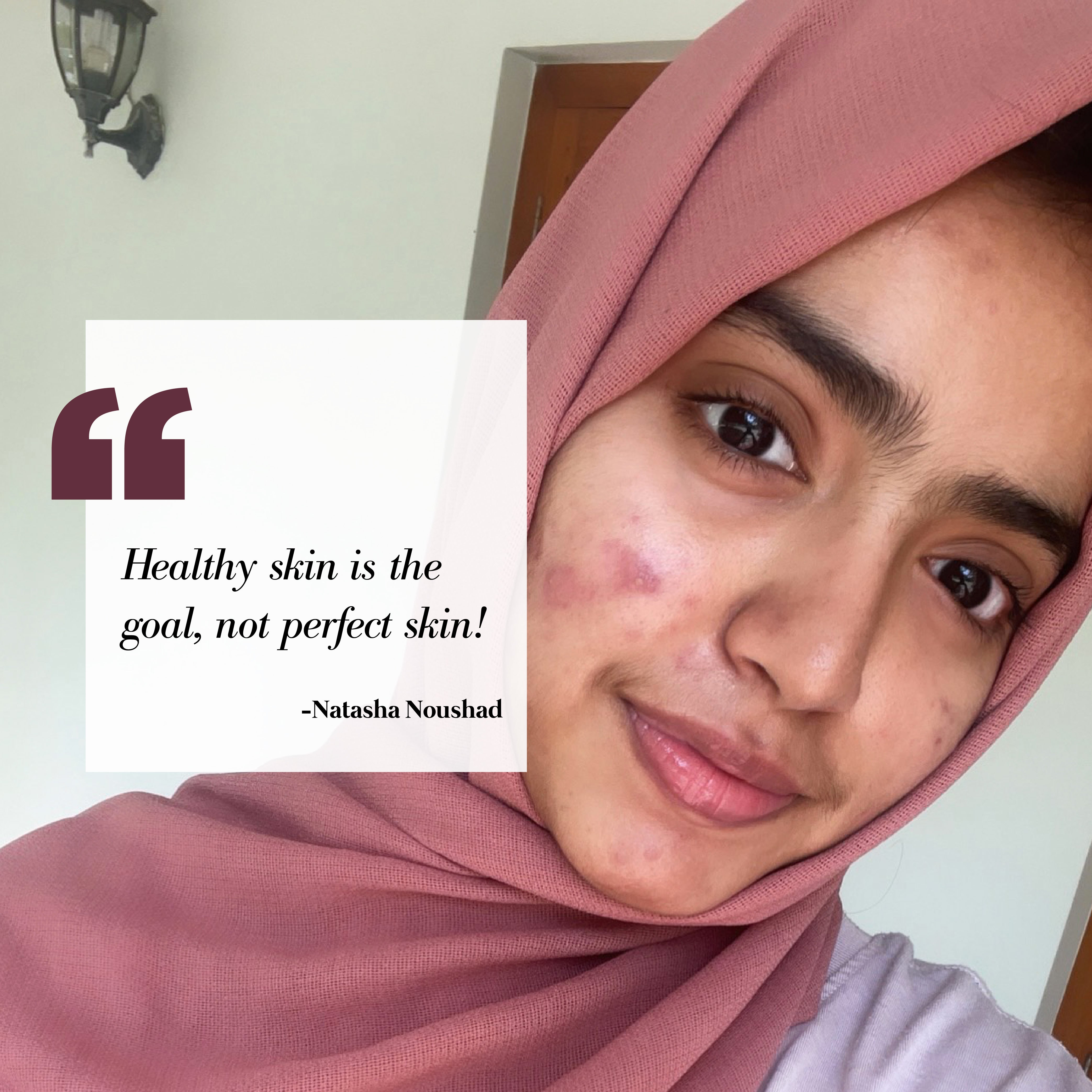 This is an image of Natasha Noushad for a blog on acne and mental health on www.sublimelife.in 