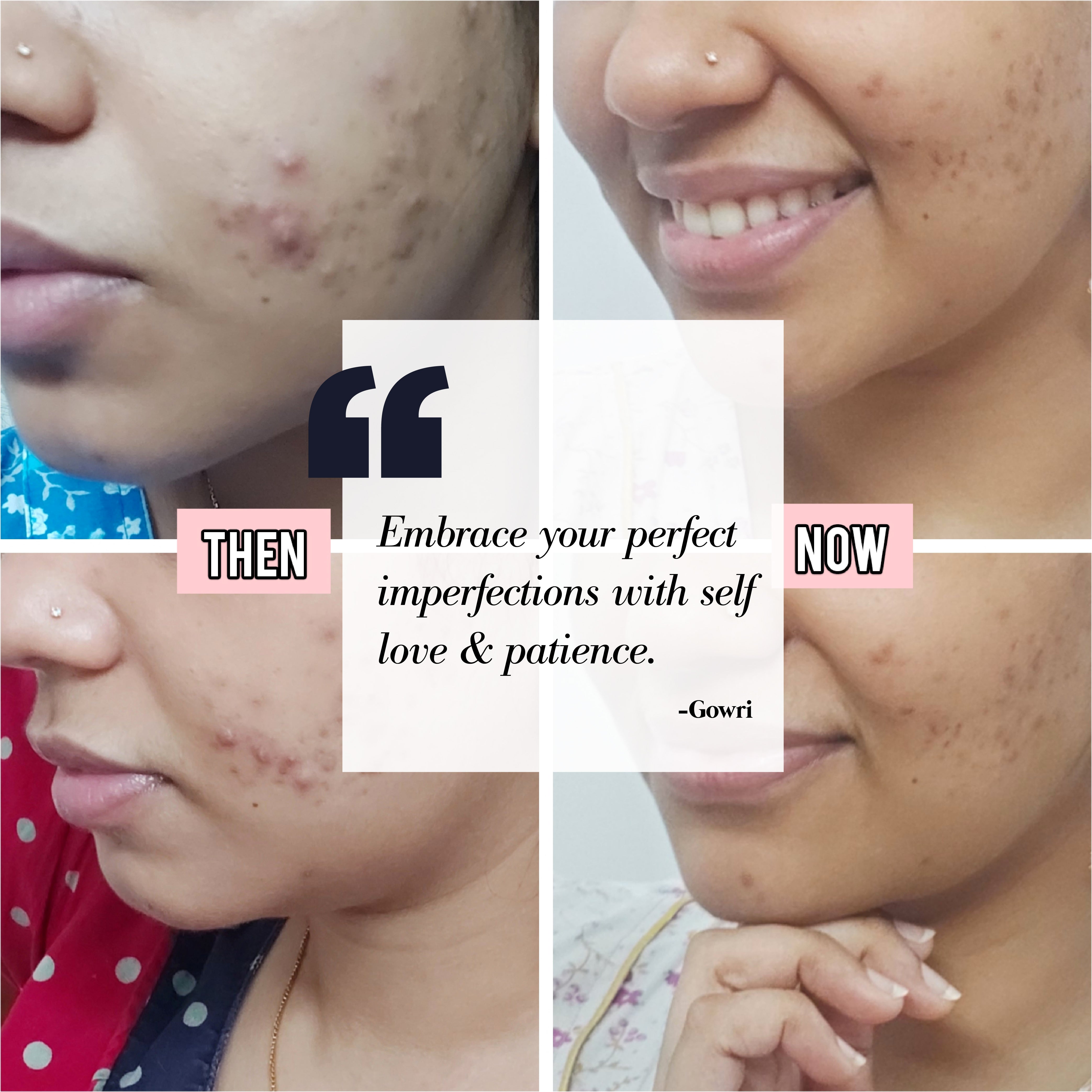 This is an image of Gowri for a blog on acne and mental health on www.sublimelife.in 