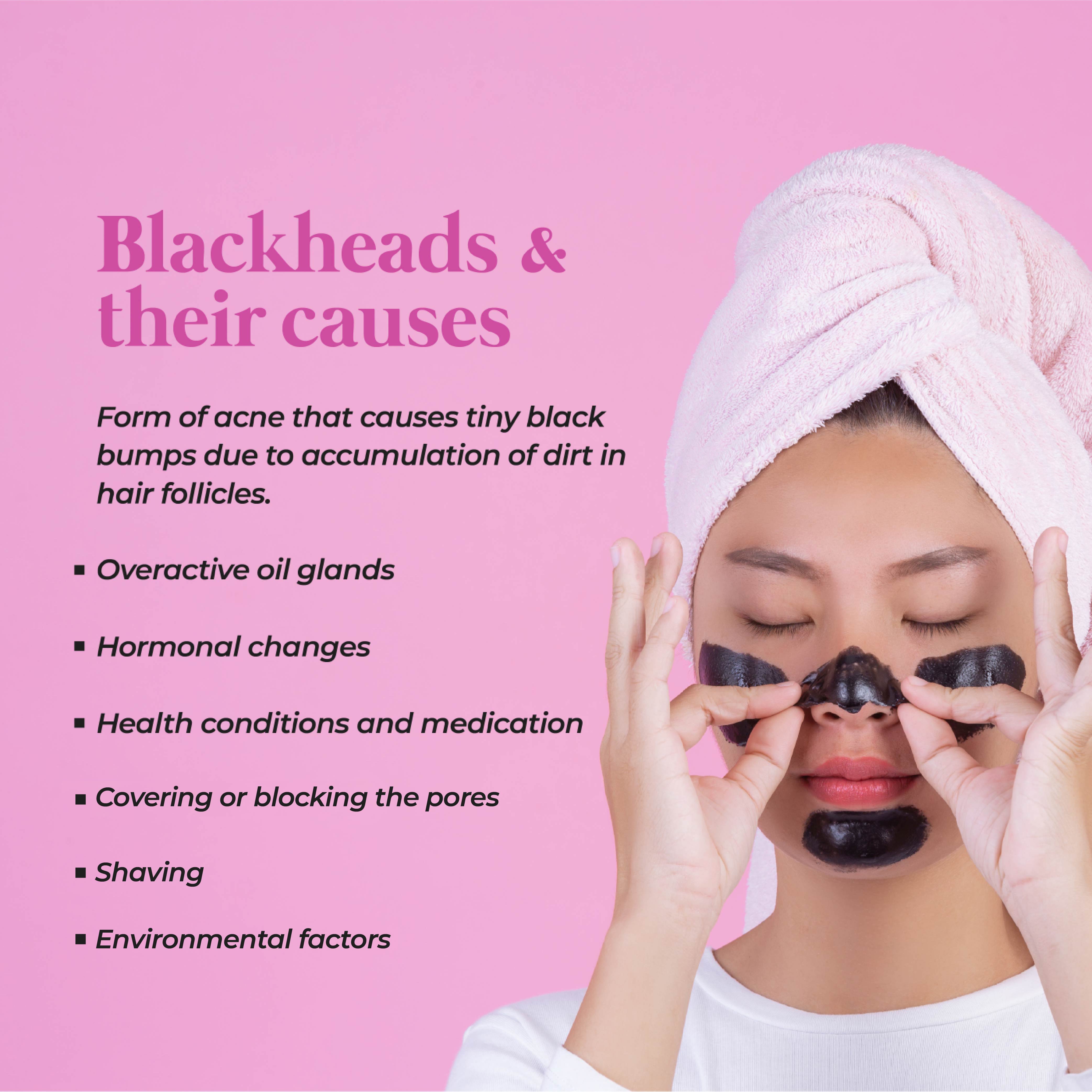 This is an image of what are blackheads and their causes