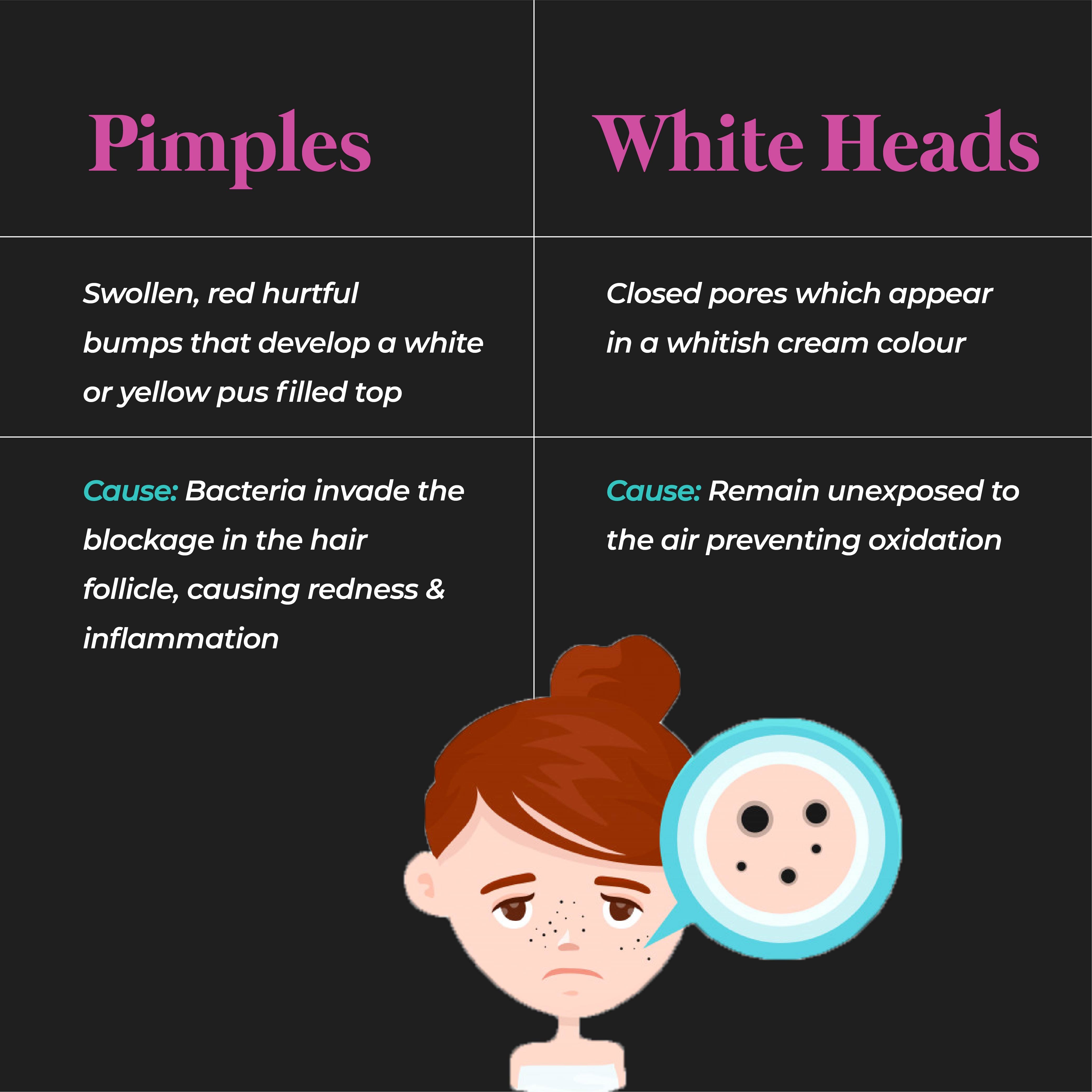 This is an image of the difference between pimples and whiteheads