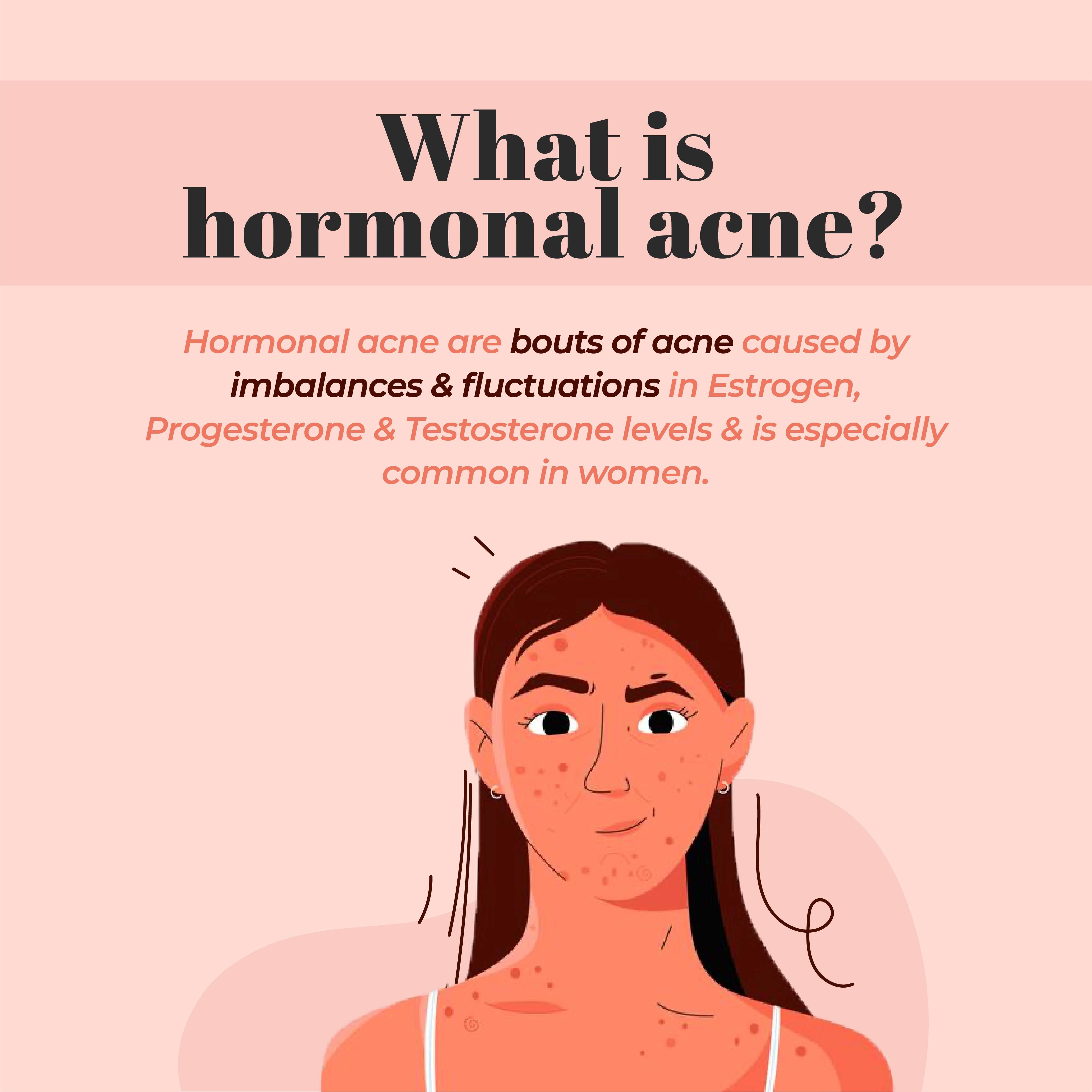 This is an image of what is hormonal acne
