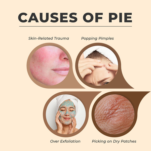 This is an image of Causes of PIE on www.sublimelife.in 