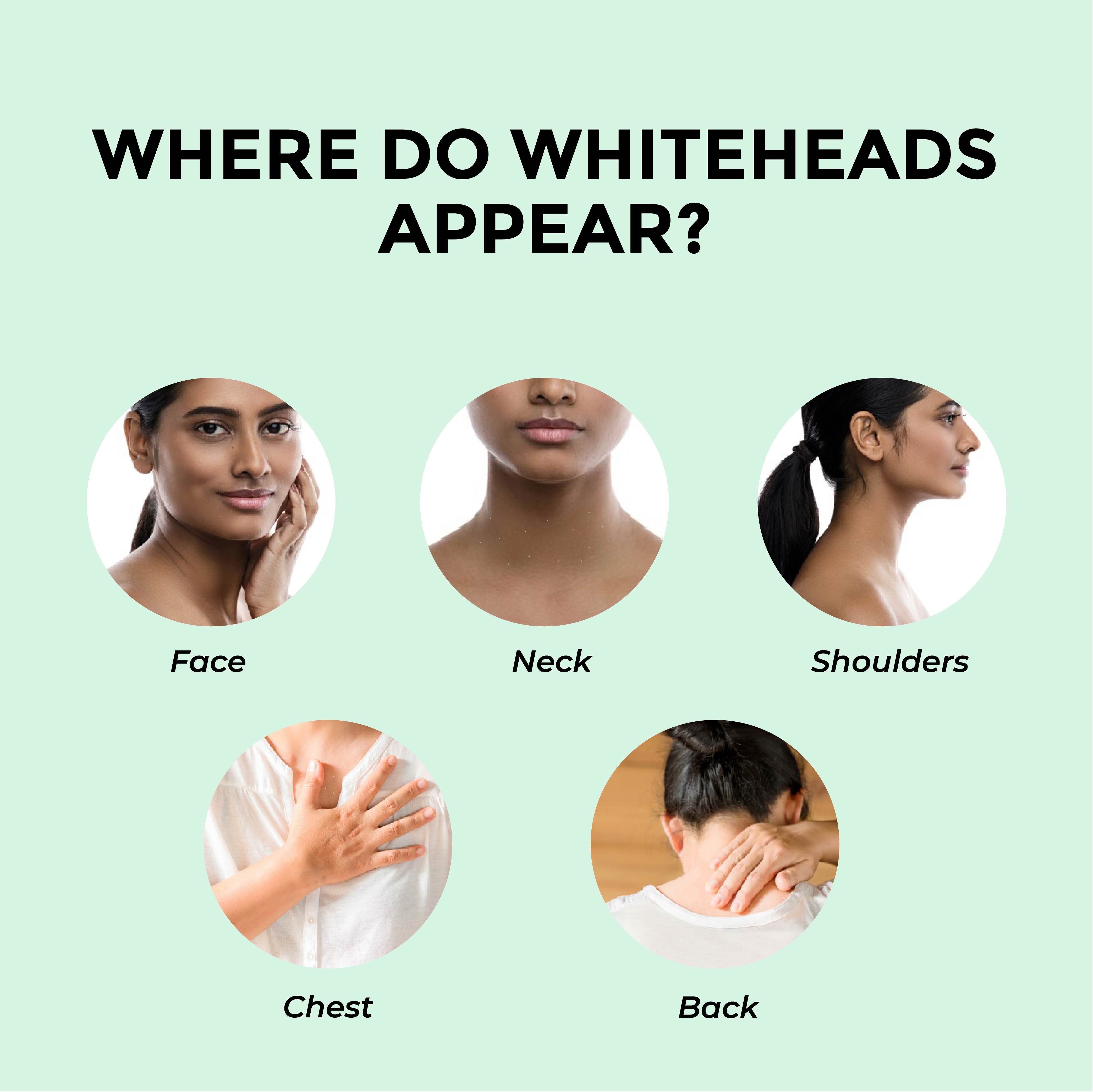 This is an image of where do whiteheads appear on www.sublimelife.in 