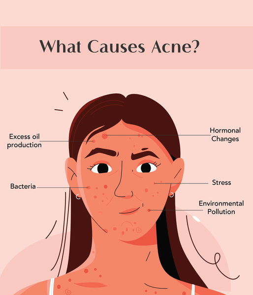 This is an image of Causes of acne in skincare on www.sublimelife.in 
