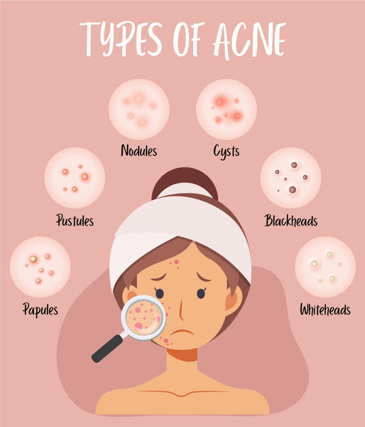 This is an image of Acne and types of Acne on www.sublimelife.in