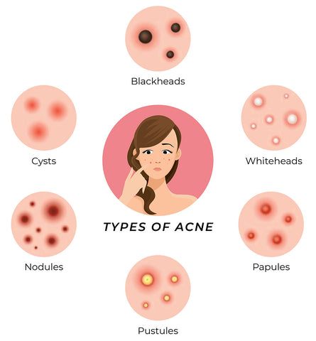 This is an image showing different types of acne prone to oily skin