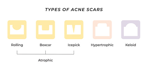 This is an infographics showing different types of acne scars