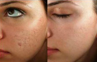 microneedling before and after