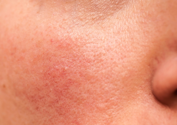  A person with rosacea on their cheek