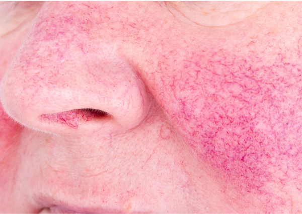  A person with redness, visible veins and rosacea on their skin