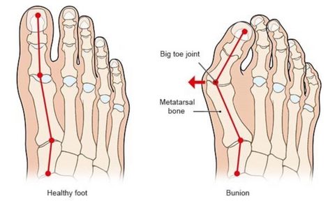 Bunions