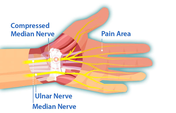 Symptom of Carpal Tunnel Syndrome