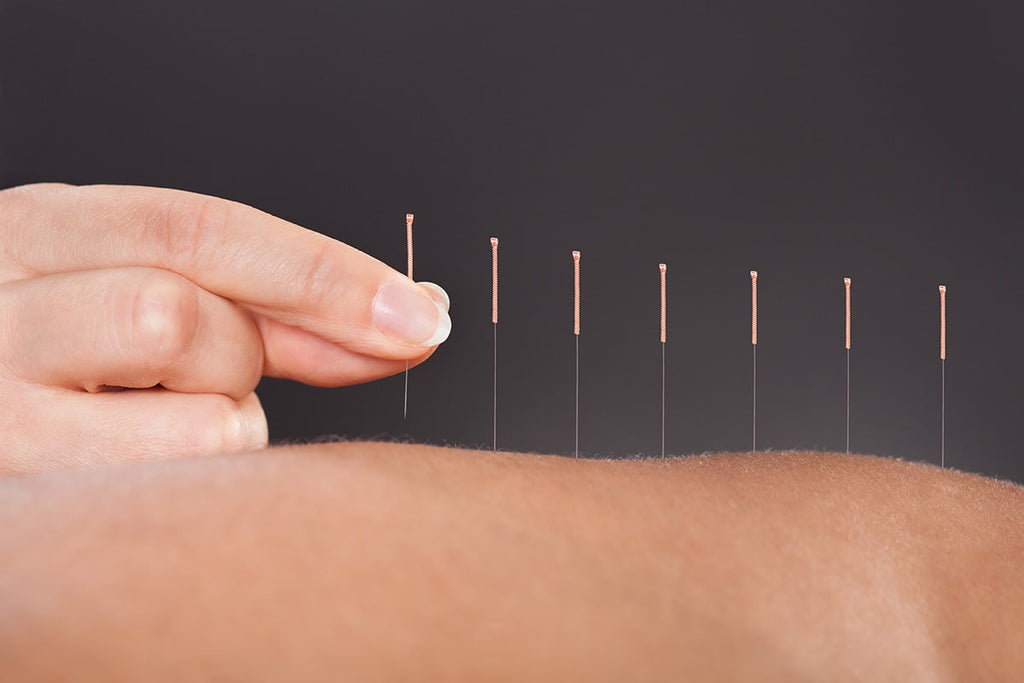 man receiving acupuncture treatment