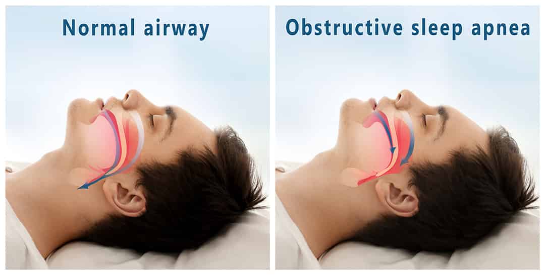 OSA is characterized by repeated episodes of complete or partial blockage of the upper airway during sleep, leading to interrupted breathing and fragmented sleep.