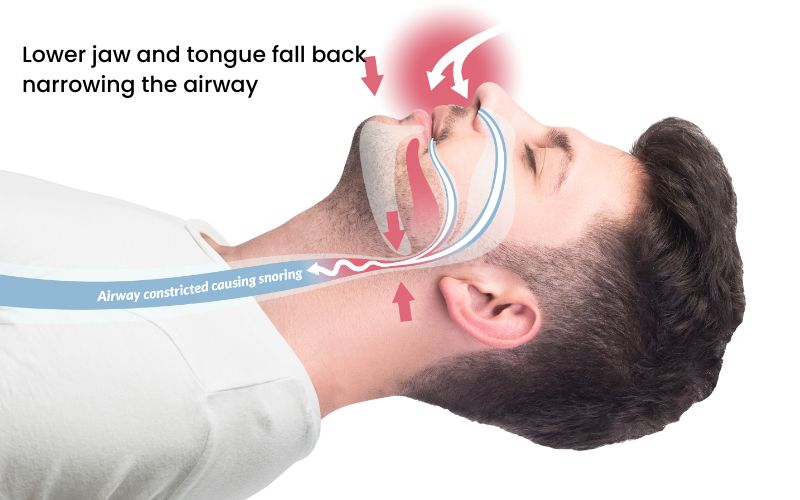 diagram of snoring