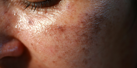 Image of woman skin with hyperpigmentation