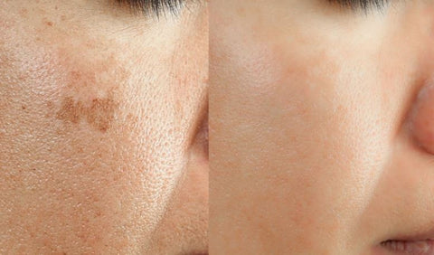 example of age spots on the skin