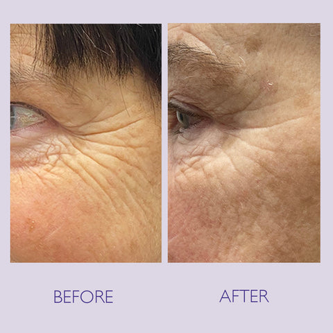 Before and after image showing a reduction in depth of eye wrinkles after using SKINICIAN Overnight Retinol Powerbalm