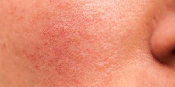 image of impaired skin barrier