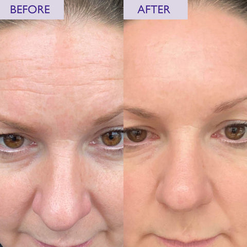 Before and after image showing retinol results