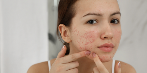 Image of teenager with acne