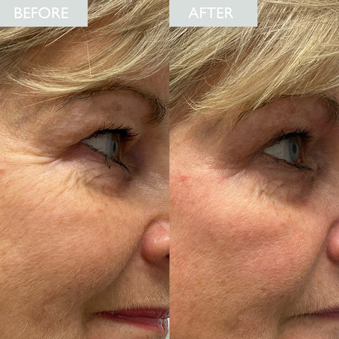Diane's before and after using Hyaluronic Elixir