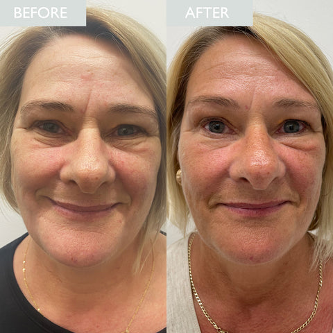 Janice Before and After Ageing Skin Journey