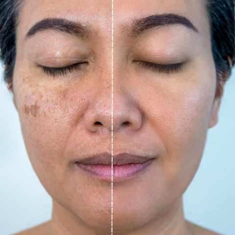 Showing skin with and without pigmentation