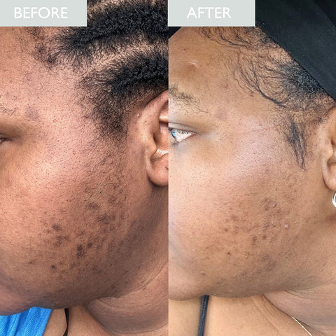 Ruth's progress on oily skin journey after 3 weeks