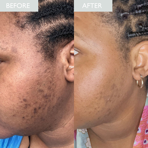 Ruth's before and after 6 week oily skin journey