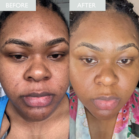 Before and after of Ruth's oily and pigmentation skin journey