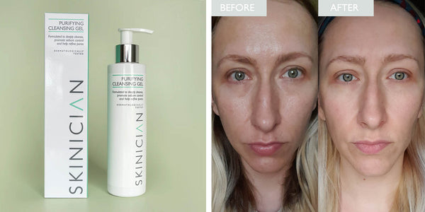 SKINICIAN Purifying Cleansing Gel with before and after