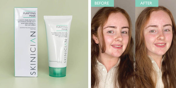 image of SKINICIAN Purifying Mask with Before and After