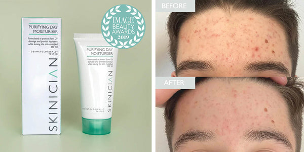SKINICIAN Purifying Day Moisturiser with before and after