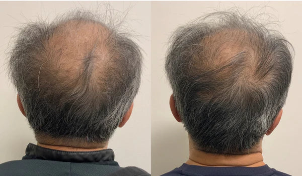 Dutasteride and Minoxidil Before and After Photos  Hair Loss Cure 2020