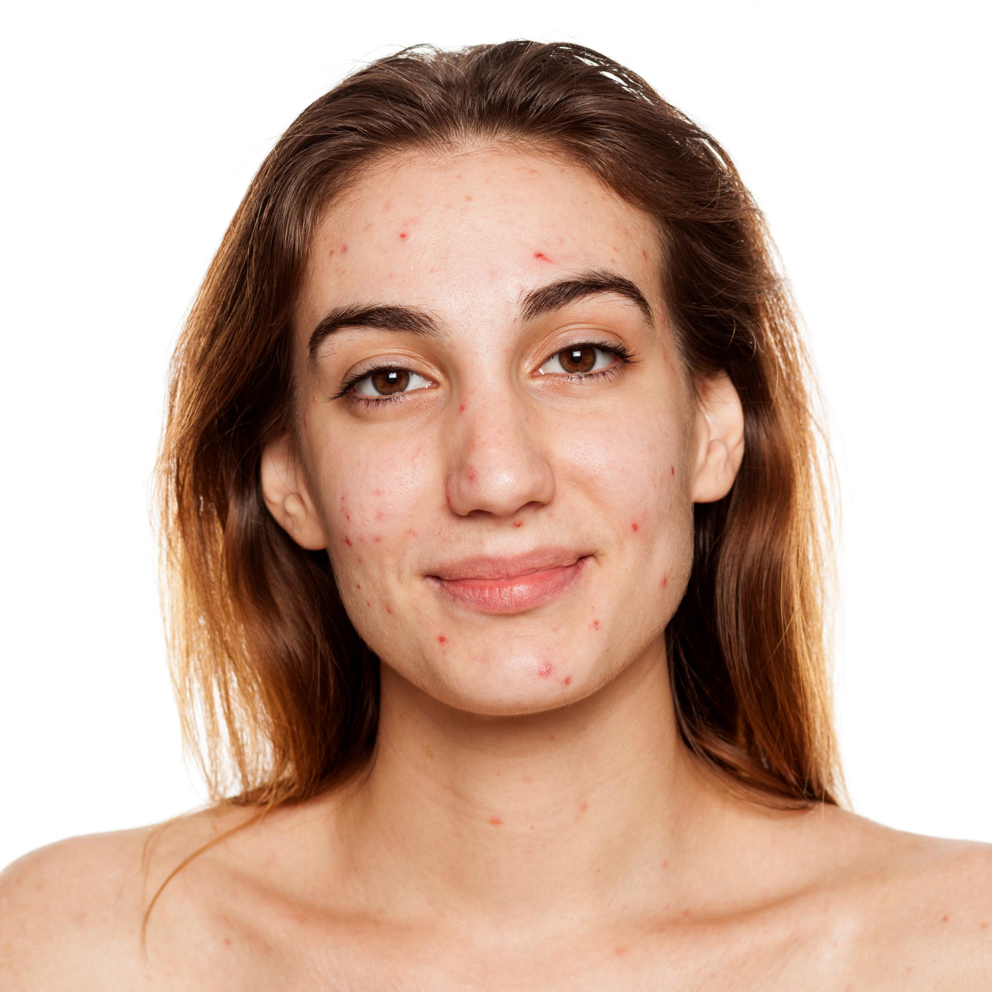 Acne Prone Skin