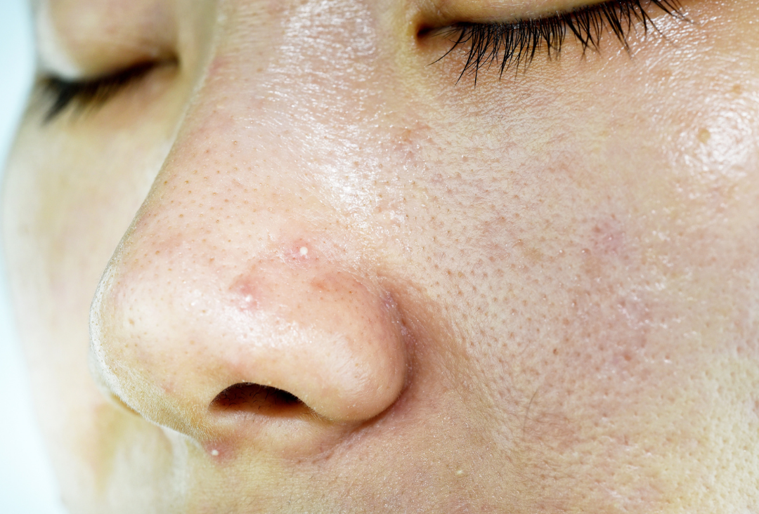 Woman with whiteheads