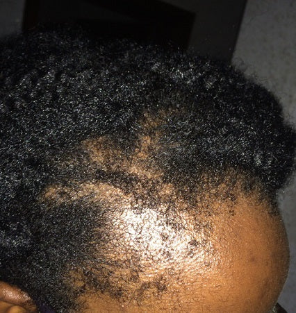 How to grow back, protect and maintain your edges from hair loss