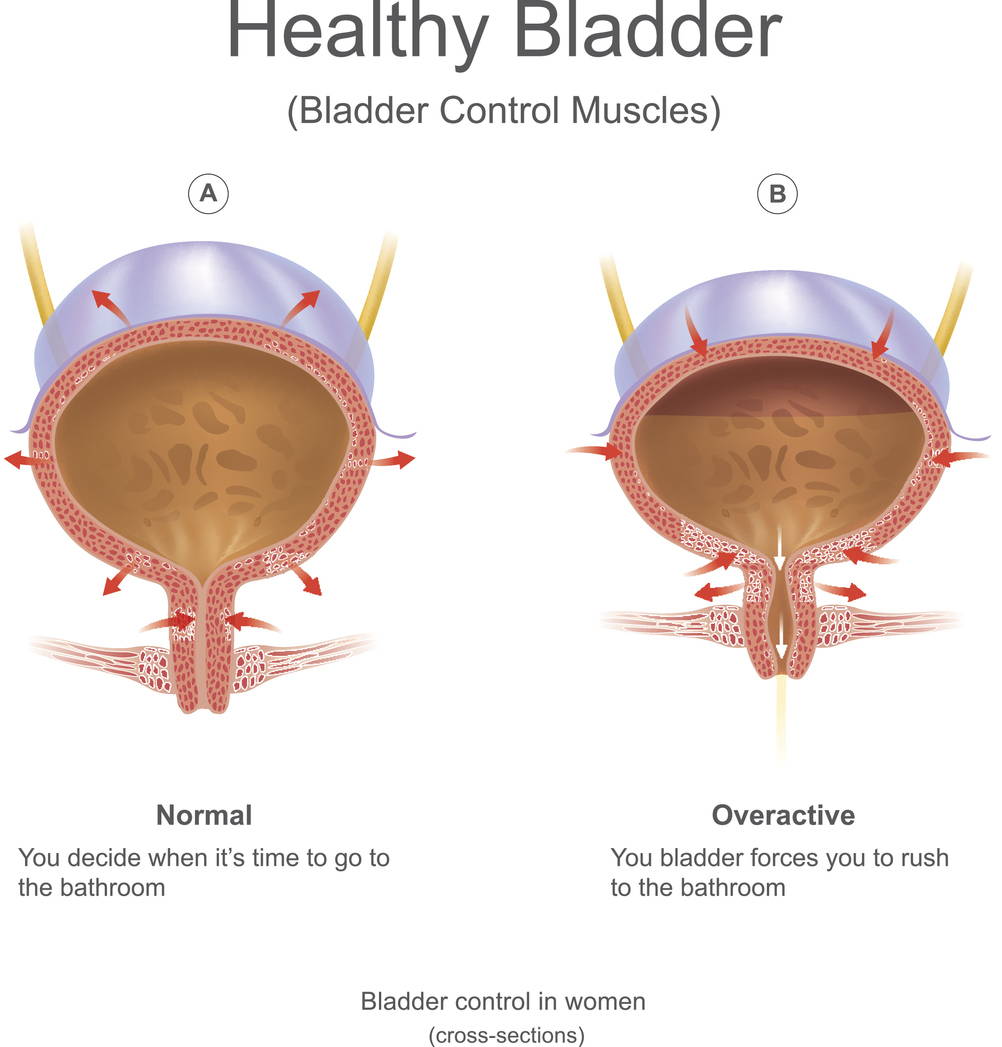 What Causes Bladder Leakage? Types & Causes of Urinary Incontinence – Proof