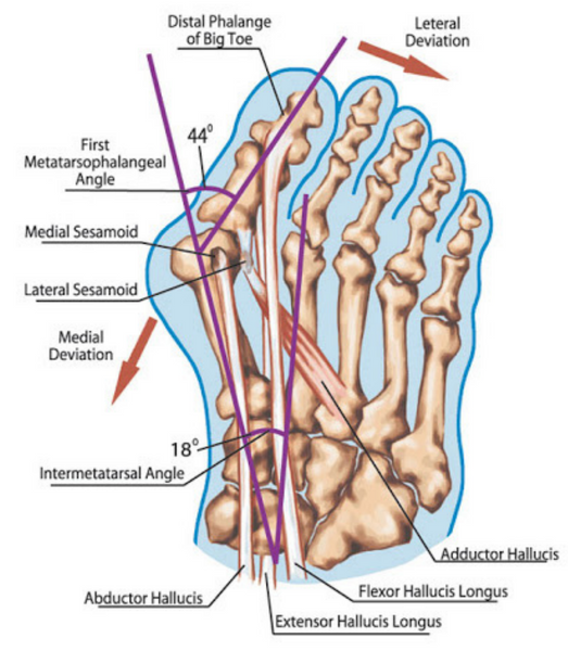 bunion forming