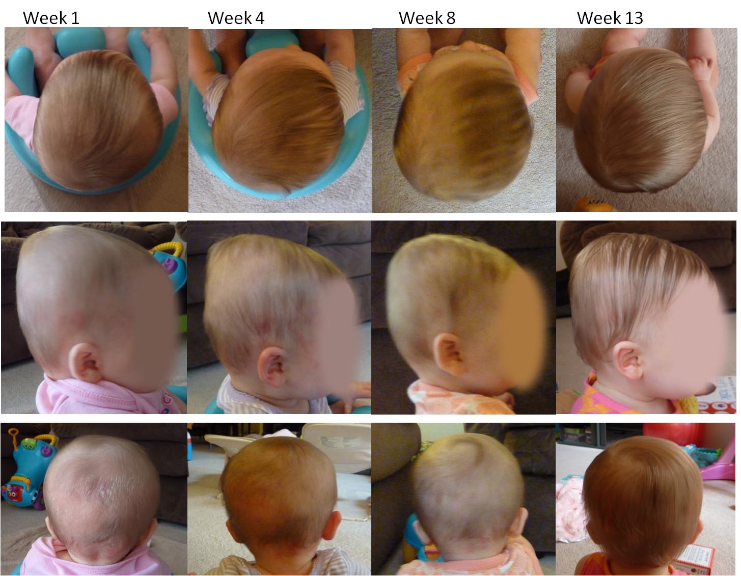 Затылок у ребенка в год. Плагиоцефалия черепа у детей. Плагиоцефалия шлем. Правильная форма головы у ребёнка.