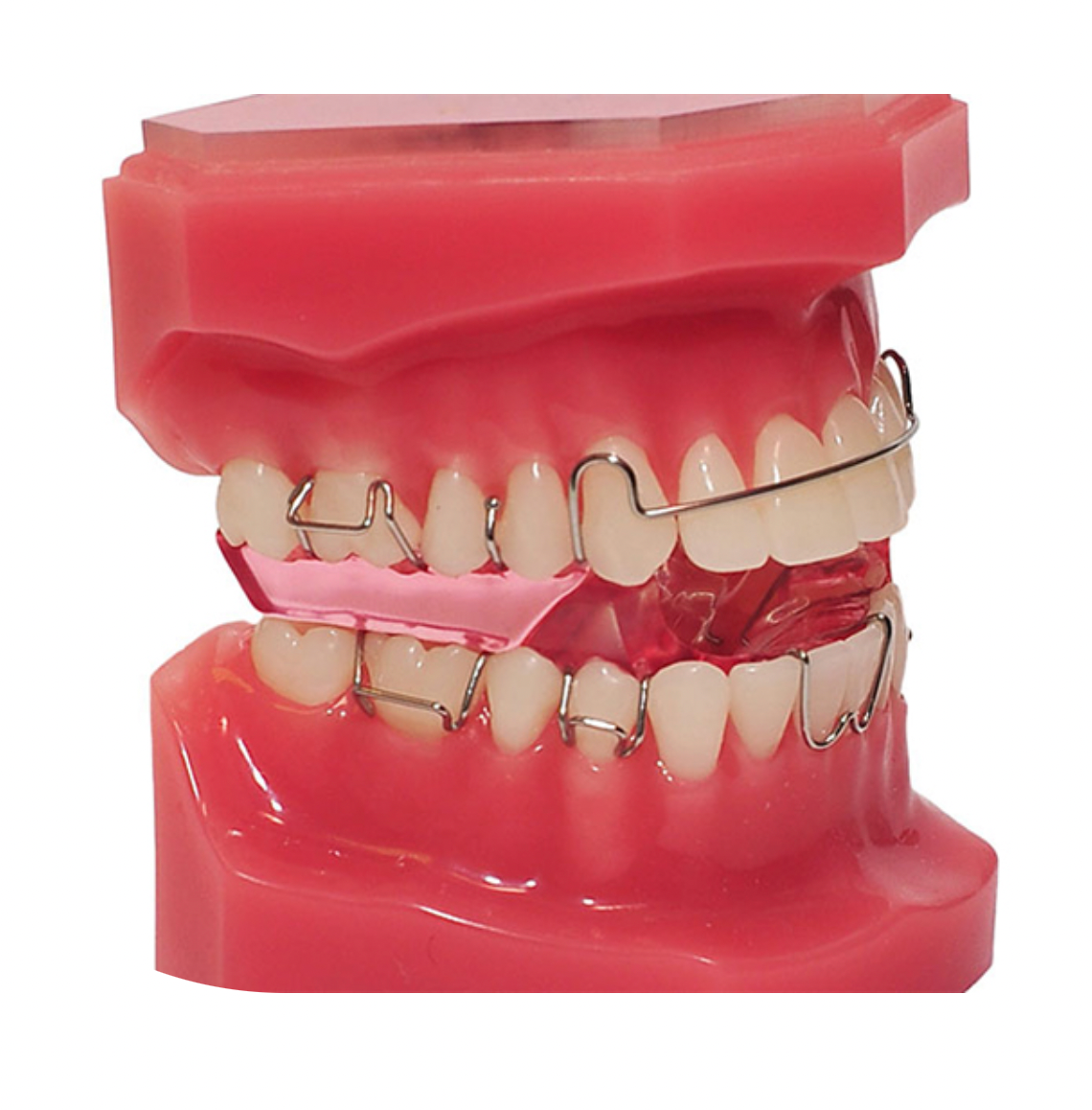 Moonee Ponds Orthodontics  Are Clear or Metal Braces Better?